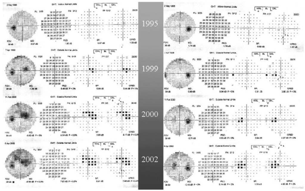 Fig. 1. Humphrey visual field (VF) findings in a 70-year-old woman with hydroxychloroquine retinal toxicity showing progressive VF loss from 1999–2002. The patient stopped hydroxychloroquine in 2000.