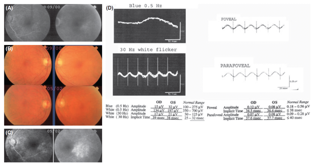 Fig. 2. A Fluorescein angiogram FA in 2000 OS with early and late frames showing hyperfluorescence in the parafoveal area. B Fundus